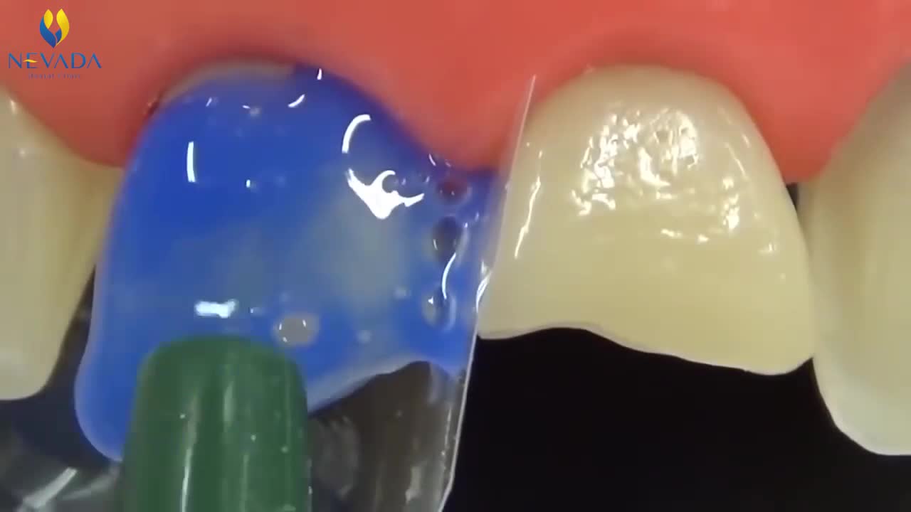 Hàn răng mẻ ảnh hưởng đến thẩm mỹ răng miệng như thế nào?
