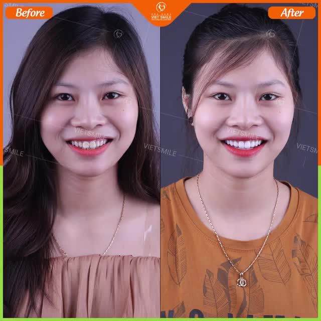 RĂNG NHIỄM FLOUR PHẢI LÀM SAO?