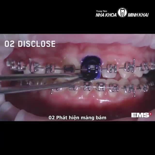 “Rung rinh” ngay từ lần đầu tiên sử dụng, đã tìm ra “chân ái” của team niềng răng