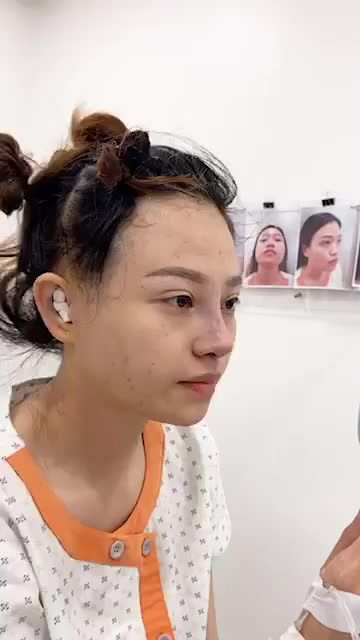 SỬA LẠI MŨI TIÊM FILLER, DA MỎNG, MŨI THẤP NGẮN
