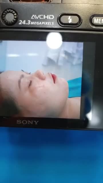 CUỐI TUẦN NGÀY CN . KHÁCH FULL TẠI BÁC SĨ KỲ Y DƯỢC  Nâng Mũi Bán cấu trúc sụn tai