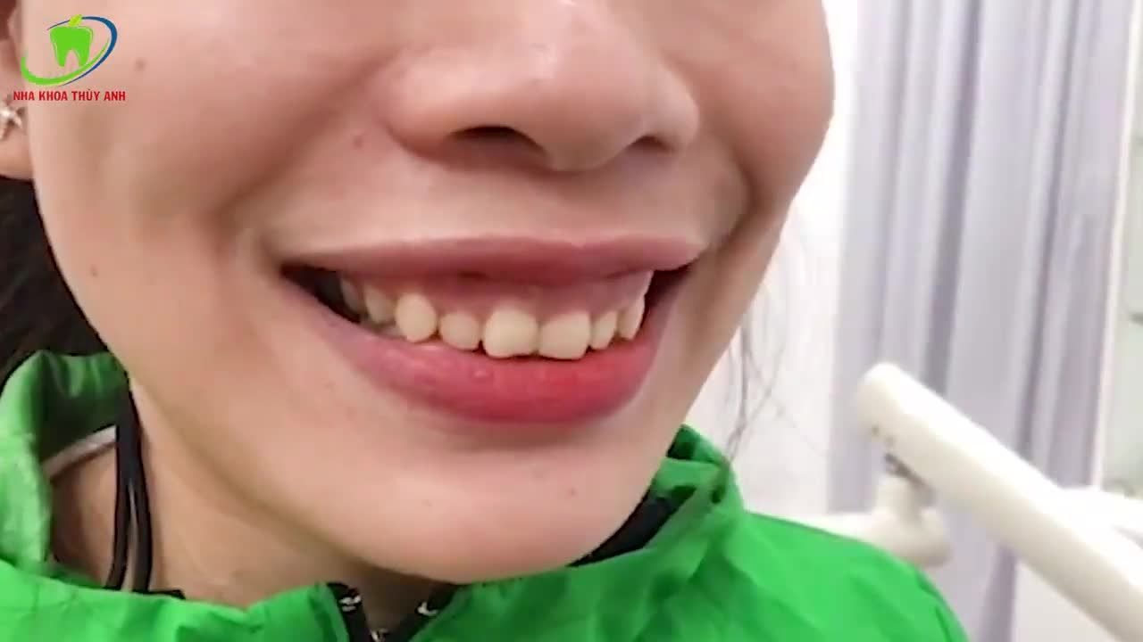 KẾT QUẢ VĨNH VIỄN SAU KHI ĐIỀU TRỊ CƯỜI HỞ LỢI.