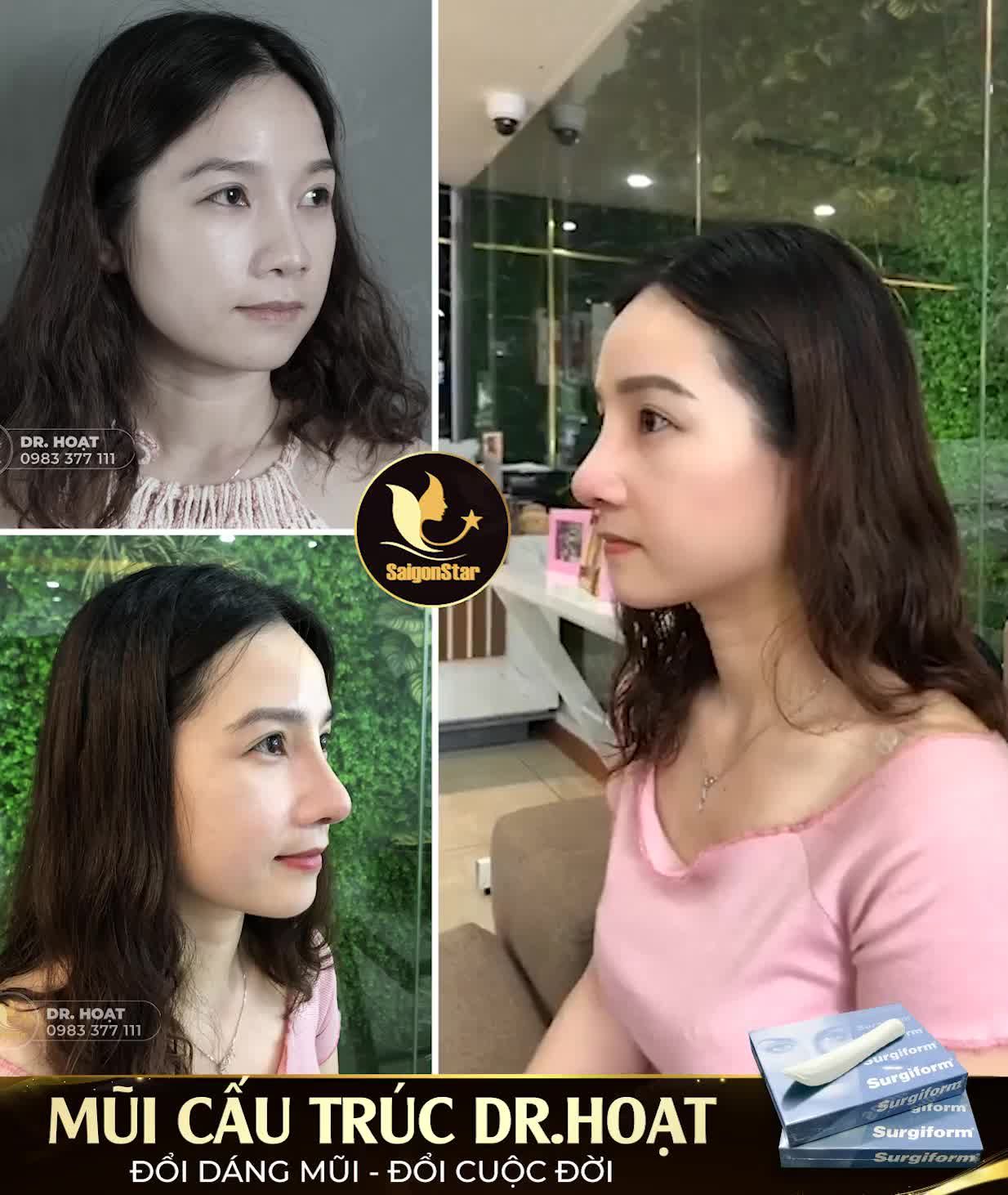 MŨI CẤU TRÚC DR.HOẠT - ĐỔI DÁNG MŨI - ĐỔI CUỘC ĐỜI