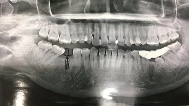 Cấy chân răng implant răng số 46 cho anh Tuấn