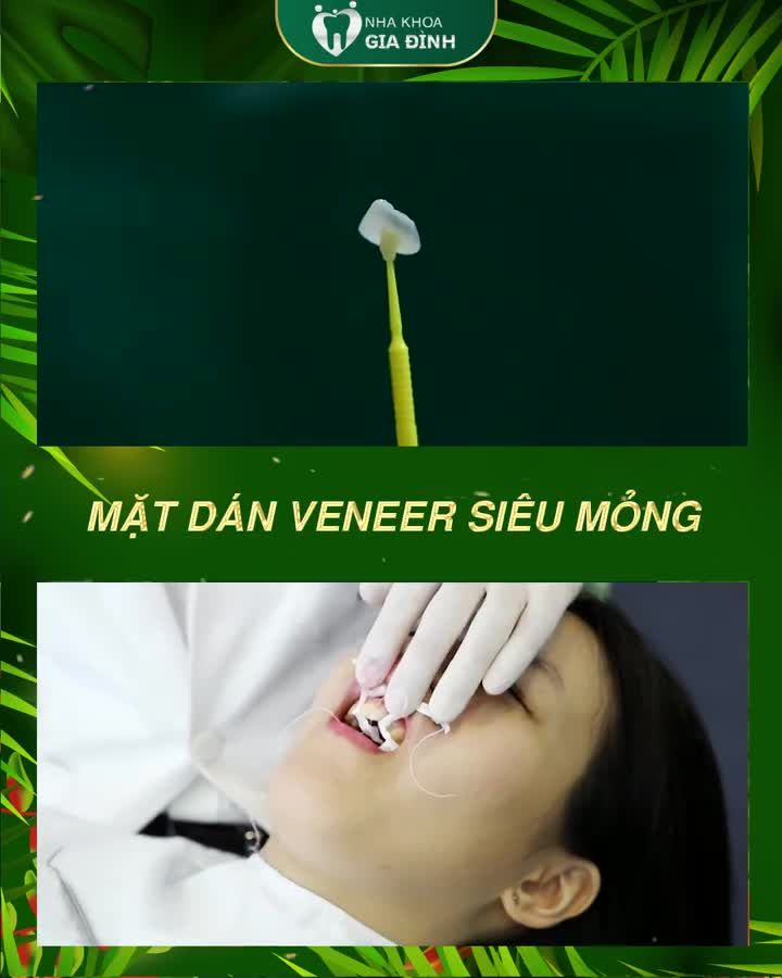 DÁN SỨ VENEER: TRẢI NGHIỆM CÙNG SAO – TRAO TRỌN NỤ CƯỜI