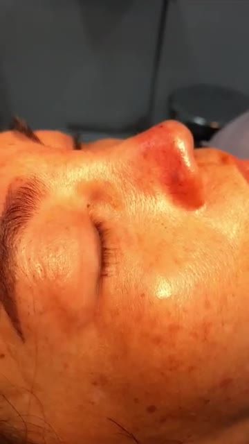 Nâng mũi bán cấu trúc đa lớp Dáng Sline tự nhiên, mềm mại Kỹ thuật độc quyền Bs Kỳ Y Dược