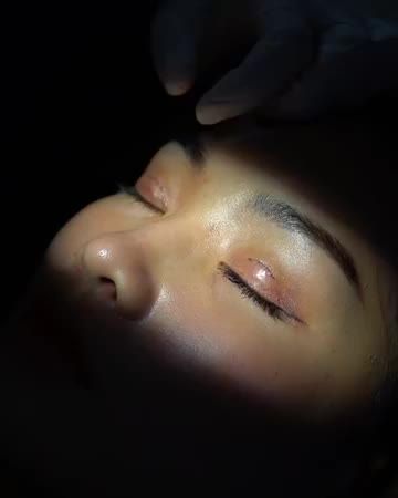 VƯỢT QUA SỰ LO LẮNG - KHÁCH HÀNG ĐẾN DR.HẢI LÊ ĐỂ CẮT MÍ DOUBLE DEEP 5D VÀ KẾT QUẢ HÀI LÒNG TRÊN CẢ SỰ MONG ĐỢI