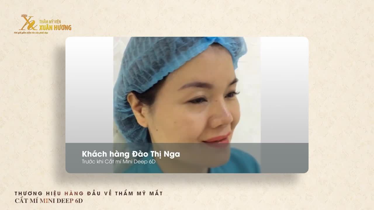 MÍ MẮT SAU 5 NGÀY CẮT MÍ MINIDEEP 6D TẠI TMV XUÂN HƯƠNG SẼ NHƯ THẾ NÀO?