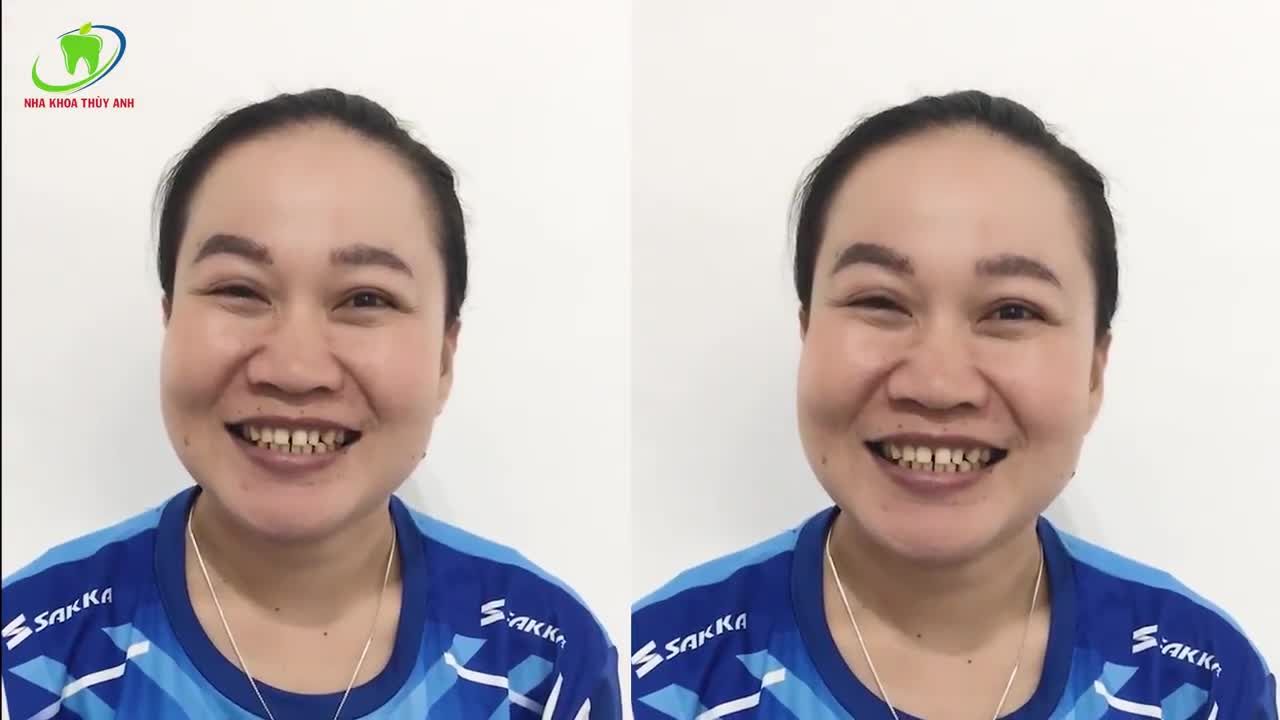 TRƯỜNG HỢP NÀO THÍCH HỢP ĐỂ DÁN VENEER