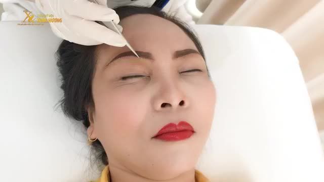 RÚT CHỈ NÂNG CUNG MÀY SAU 5 NGÀY THỰC HIỆN VÀ KẾT QUẢ THỰC SỰ BẤT NGỜ