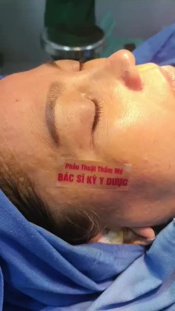 THỰC TẾ CANÂNG MŨI BÁN CẤU TRÚC SỤN TAI ĐA LỚP, CUỘN CÁNH MŨI PLASMA