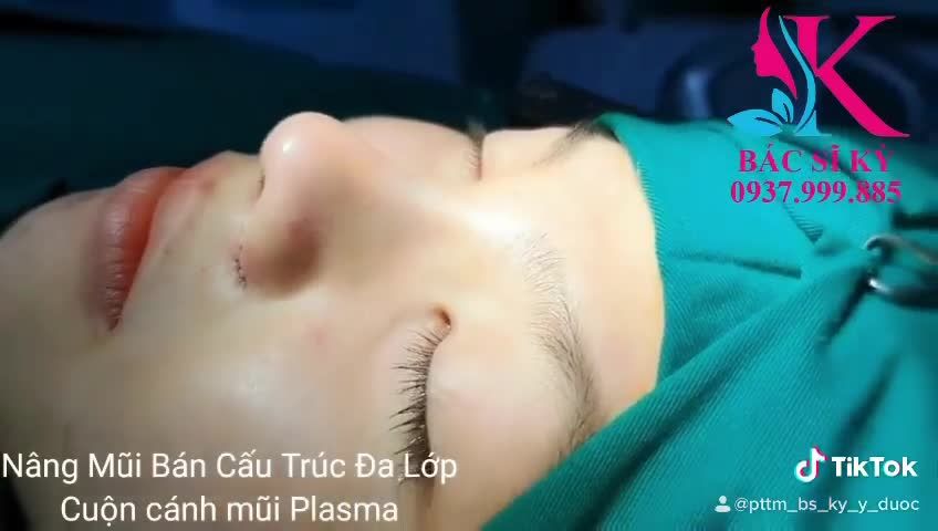 MŨI ĐẸP HOÀN HẢO SAU 45 PHÚT