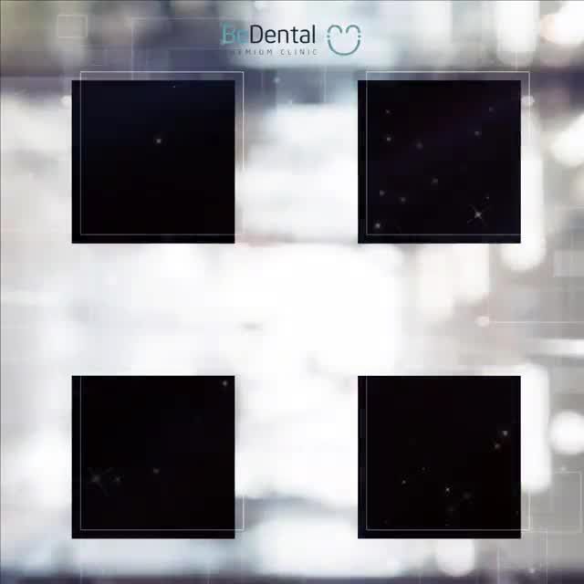 Đẹp ngay không kịp trở tayChỉ 2 ngày BEDENTAL