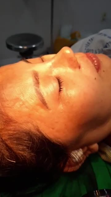 NÂNG MŨI BÁN CẤU TRÚC SỤN TAI VÀ CUỘN CÁNH MŨI PLASMA