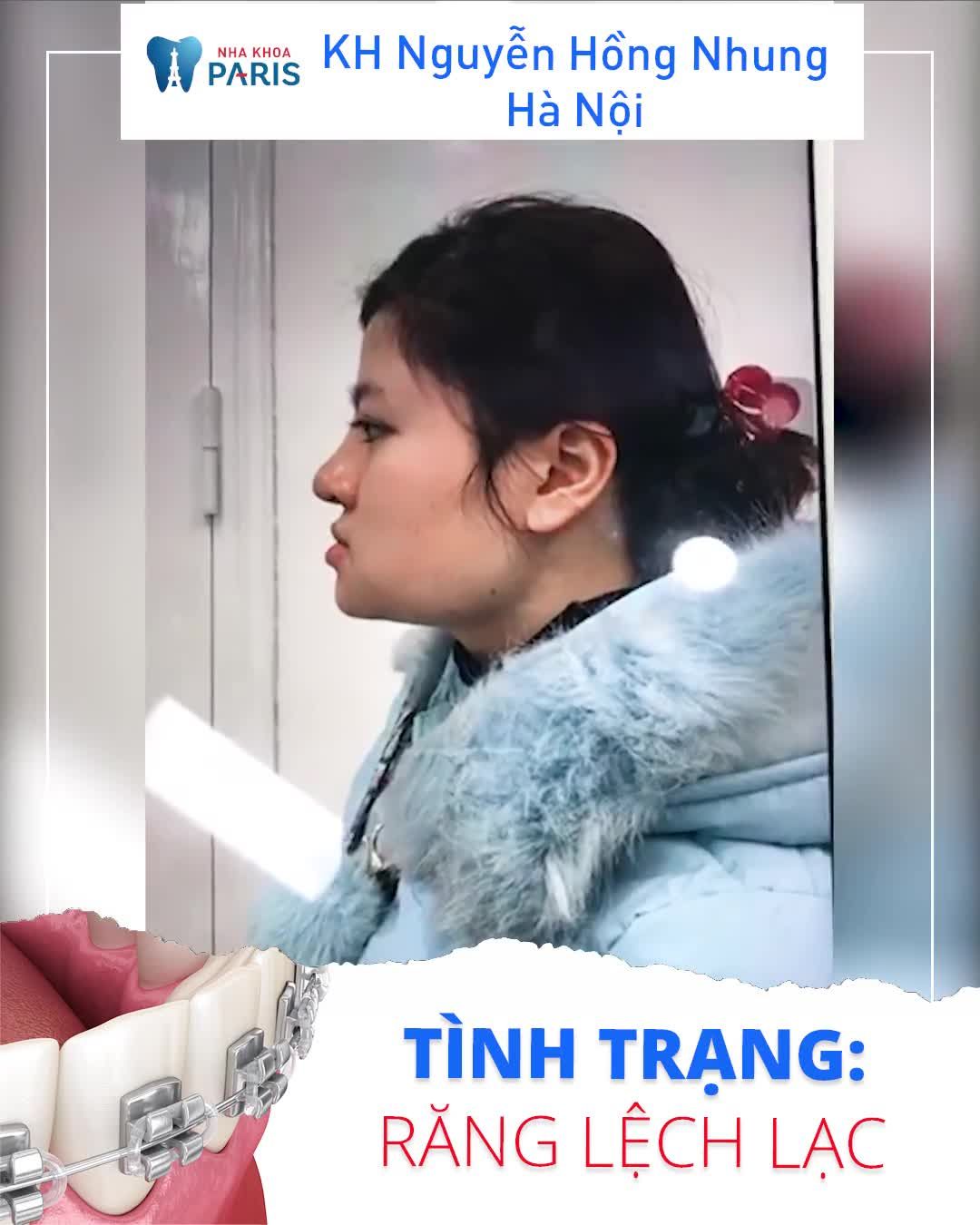 Răng Đẹp Cằm Vline Niềng Răng Thích Mê