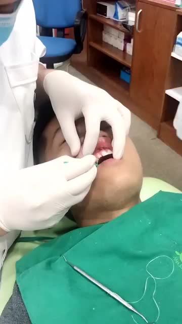 DÁN SỨ VENEER KHÔNG MÀI NHỎ, BẢO TỒN RĂNG THẬT