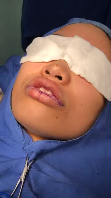Cận cảnh quá trình Tạo môi tim+ Thu mỏng môi dưới_ Thay đổi nụ cười duyên dáng cho vị Khách hàng trẻ tuổi cùng Kangnam