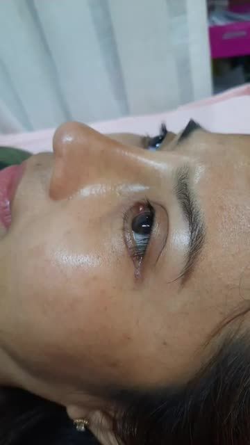 Nâng mũi bán cấu trúc đa lớp
