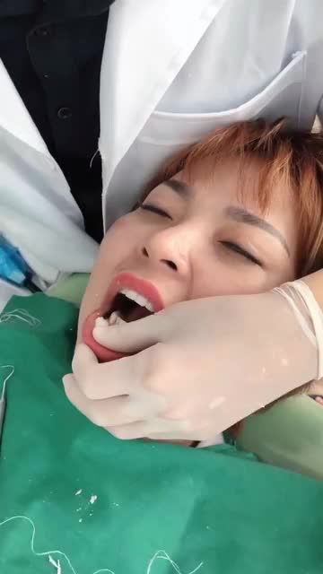 Phục hình răng ít xâm lấn với Dán sứ Veneer siêu mỏng KH Nguyễn Thị Mai, 20 Veneer Emax