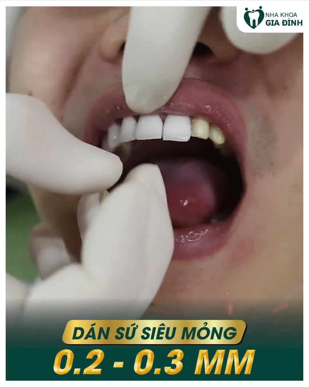 DÁN SỨ VENEER – SAO VIỆT RẠNG RỠ KHOE NỤ CƯỜI TỎA NẮNG