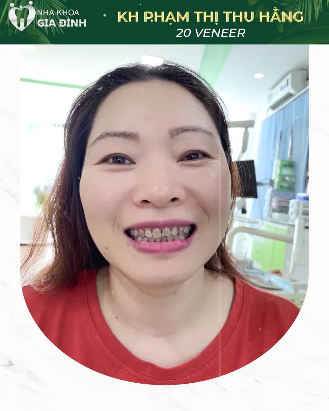 DÁN SỨ VENEER: AN TOÀN – CHẤT LƯỢNG - BỀN ĐẸP