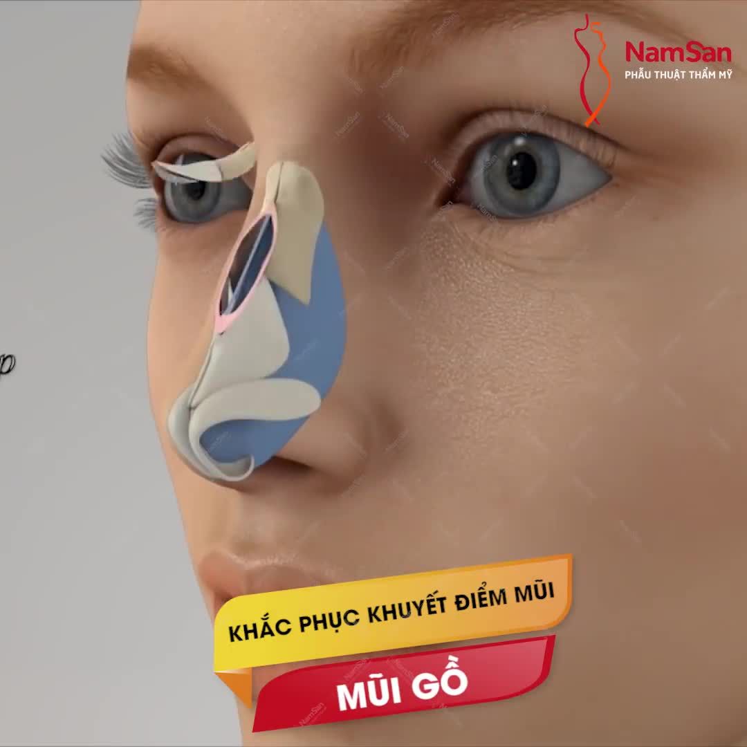 NÂNG MŨI KHÔNG ĐAU - ĐẸP TỰ NHIÊN SAU 07 NGÀY
