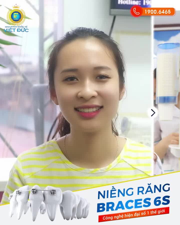 NIỀNG RĂNG BRACES 6S ĐÃ THAY ĐỔI NỤ CƯỜI CỦA KHÁCH HÀNG NHA KHOA QUỐC TẾ VIỆT ĐỨC NHƯ THẾ NÀO?