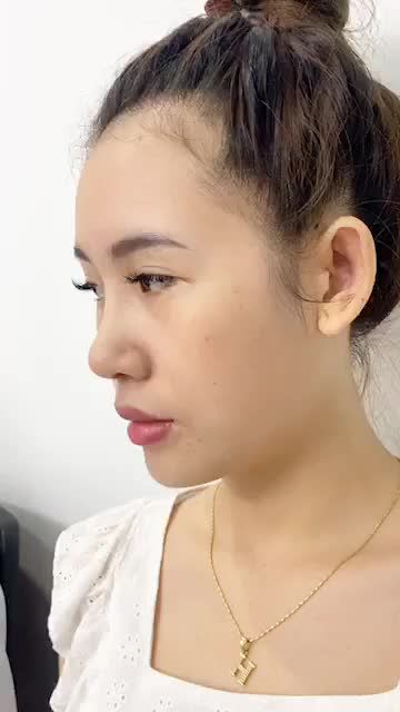 NÂNG MŨI CẤU TRÚC 4D - Mũi đẹp rạng ngời nâng tầm nhan sắc