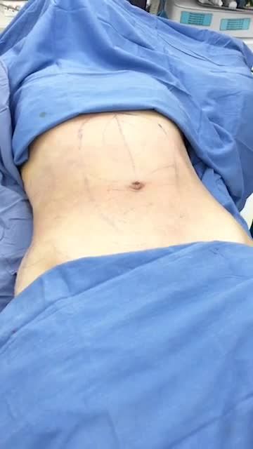 Kết quả ngay sau 60 phút của khách hàng làm dịch vụ hút mỡ bụng tại bệnh viện thẩm mỹ Kangnam