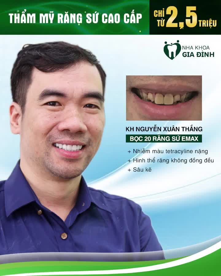 PHONG ĐỘ GIẢM SÚT CHỈ VÌ HÀM RĂNG KHIẾM KHUYẾT LẤY LẠI BẢN LĨNH PHÁI MẠNH VỚI THẨM MỸ RĂNG SỨ