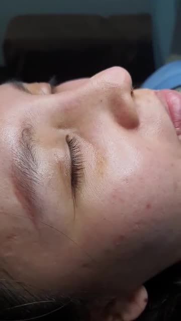 Nâng mũi Sline tự nhiên sau 10 ngày