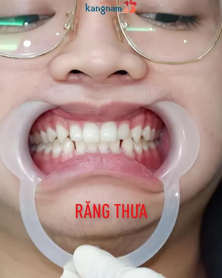 1 năm sau NIỀNG RĂNG liệu đã đều và đẹp??