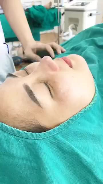 Đầu giờ chiều ngắm “sương sương” kết quả ca mũi số 3 trong ngày của bác sĩ cũng với dịch vụ nâng mũi Sline nhé!