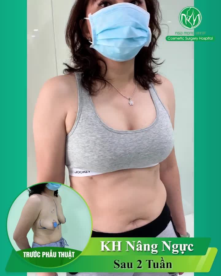 "Chưa nâng ngực thì cũng sợ lắm mà làm xong nhìn thấy thích gì đâu" Khách nhà em ai cũng than phiền vậy hết trơn nghe mà ngại ghê.