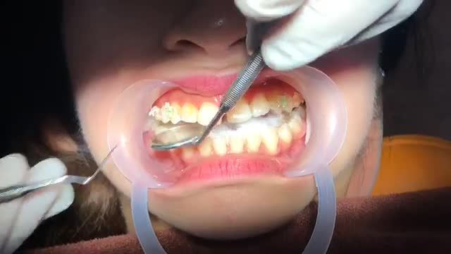 Gắn mắc cài cho khách hàng răng THƯA