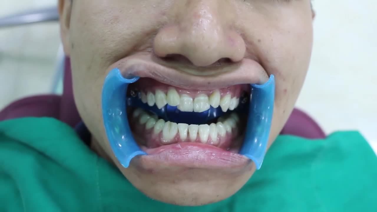NIỀNG RĂNG MỘT HÀM CÓ ĐƯỢC KHÔNG?