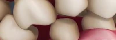 TÁC HẠI KHÔN LƯỜNG CỦA VIỆC MẤT RĂNG?