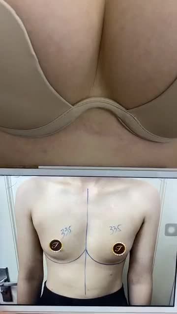 Tái khám phẫu thuật nâng V1 Bác sỹ Dương Văn Tươi - Thẩm mỹ Saigon Young