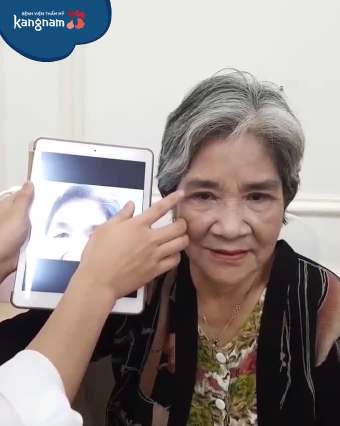 Khách hàng 72 TUỔI ‼️ Lột Xác sau CẮT MÍ
