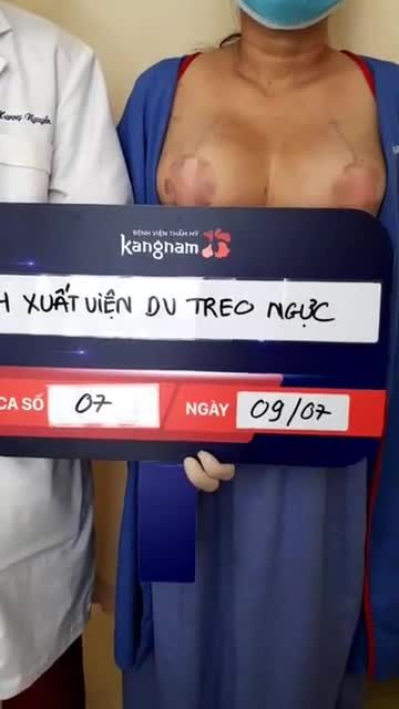 NGỰC TRÁI MƯỚP SAU KHI SINH? BIẾN HÓA NGOẠN MỤC SAU 24H VỚI DỊCH VỤ TREO NGỰC SA TRỄ TẠI KANGNAM SÀI GÒN