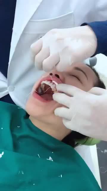 DÁN SỨ VENEER: BỀN CHẮC DÀI LÂU - ĂN NHAI THOẢI MÁI