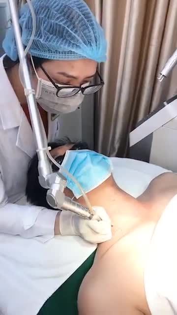 Điều trị MỤN THỊT bằng Công Nghệ LASER CO2 SIÊU XUNG hiệu quả sau 1 LẦN.
