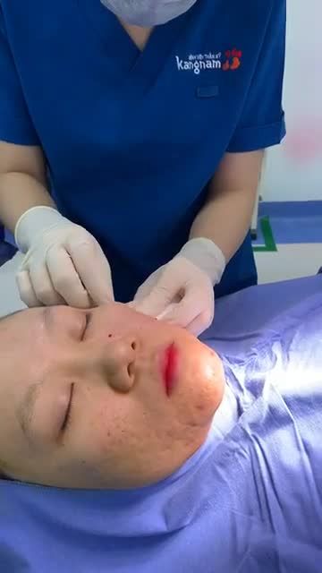 MỤN GÂY RA SẸO LÕM, ĐIỀU TRỊ THẾ NÀO?
