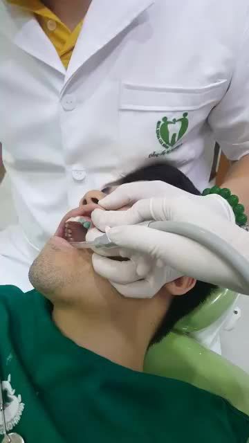 Quá trình dán sứ Veneer cho KH Mạnh Hùng