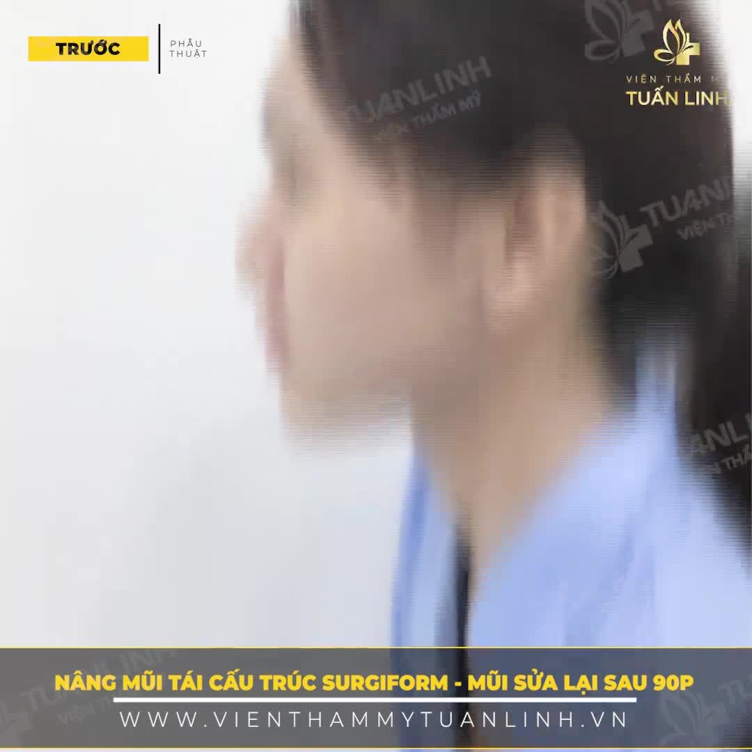 CẬN CẢNH DÁNG MŨI SỬA LẠI 90P PHẪU THUẬT
