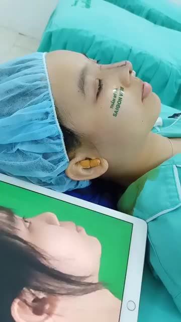 GƯƠNG MẶT ĐẸP HƠN SAU KHI NÂNG MŨI TẠI SÀI GÒN VENUS