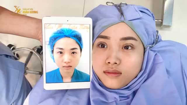 MÀN "LỘT XÁC" ĐẦY BẤT NGỜ CHỈ SAU 15 PHÚT NHẤN MÍ EYELID PLUS