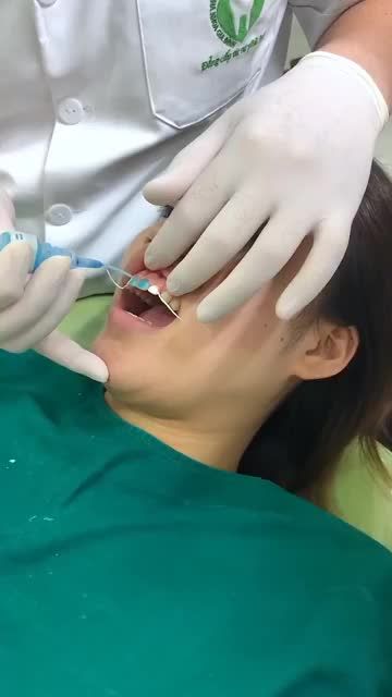 DÁN SỨ VENEER KHÔNG MÀI RĂNG LÀ CÓ THẬT!