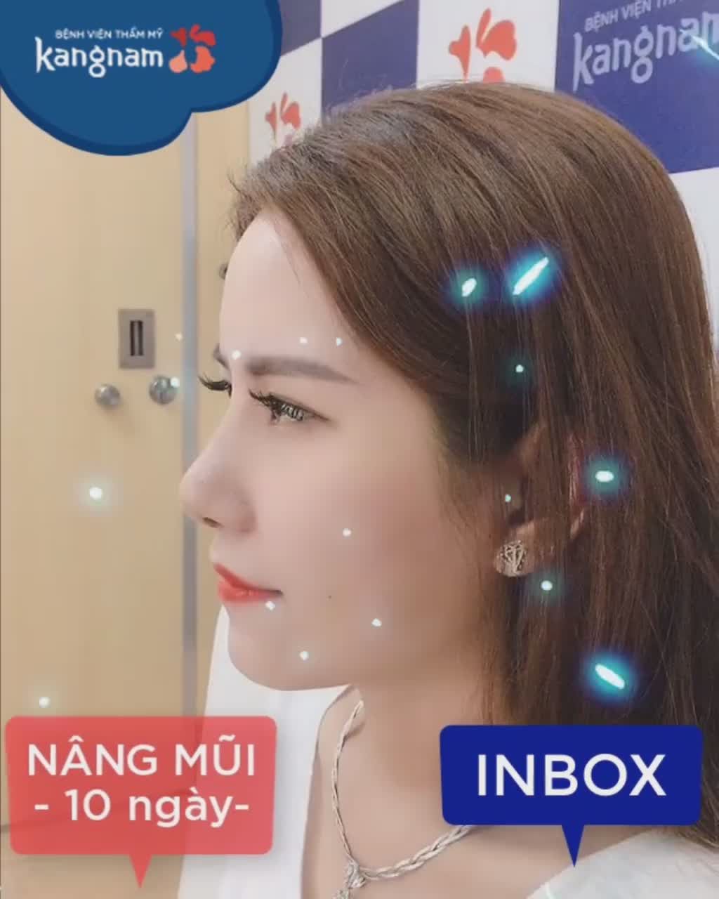 NÂNG MŨI xinh hơn - Trẻ hơn là có thật chị em ạ!