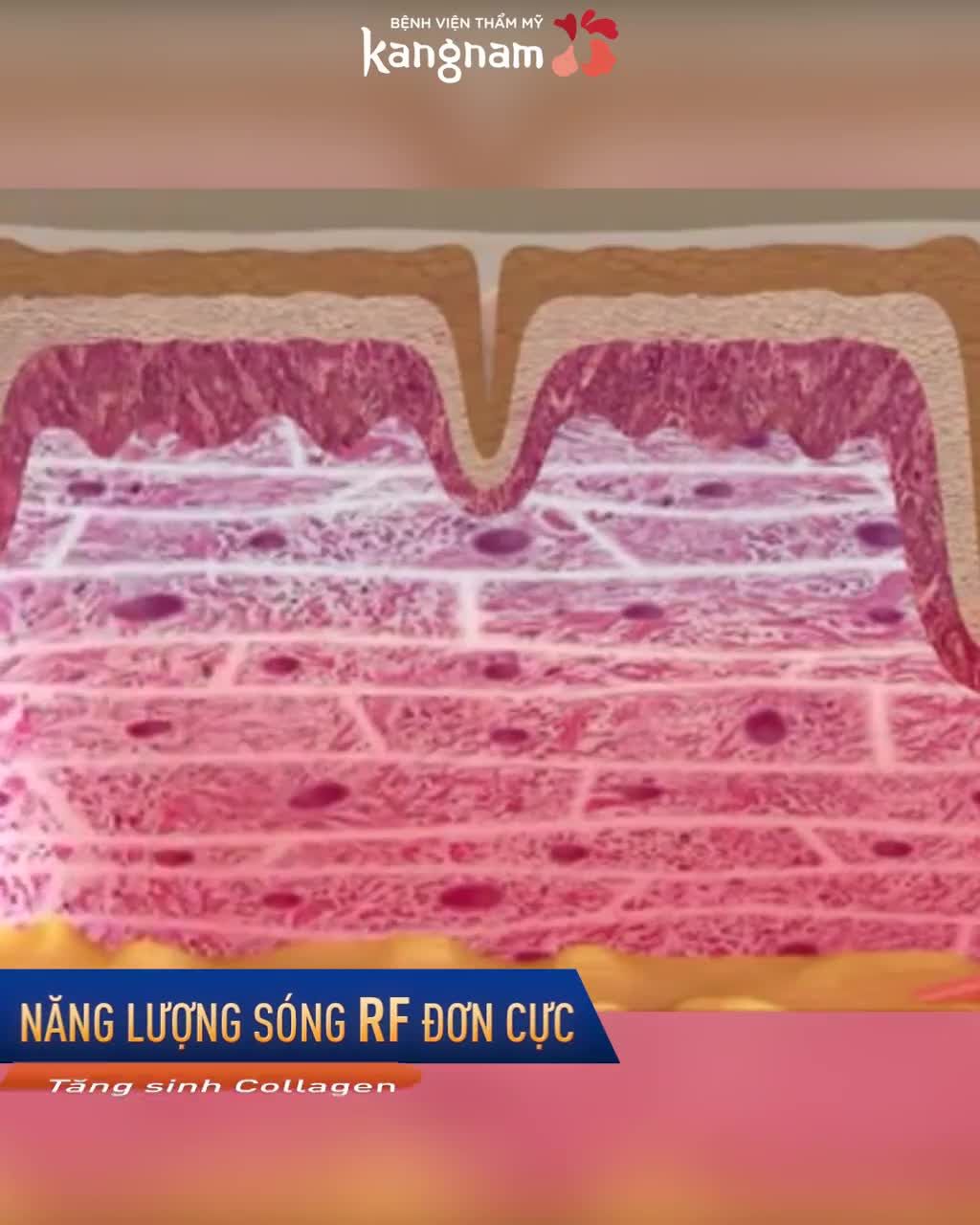 Tại sao THERMAGE FLX lại được chị em yêu thích đến thế?